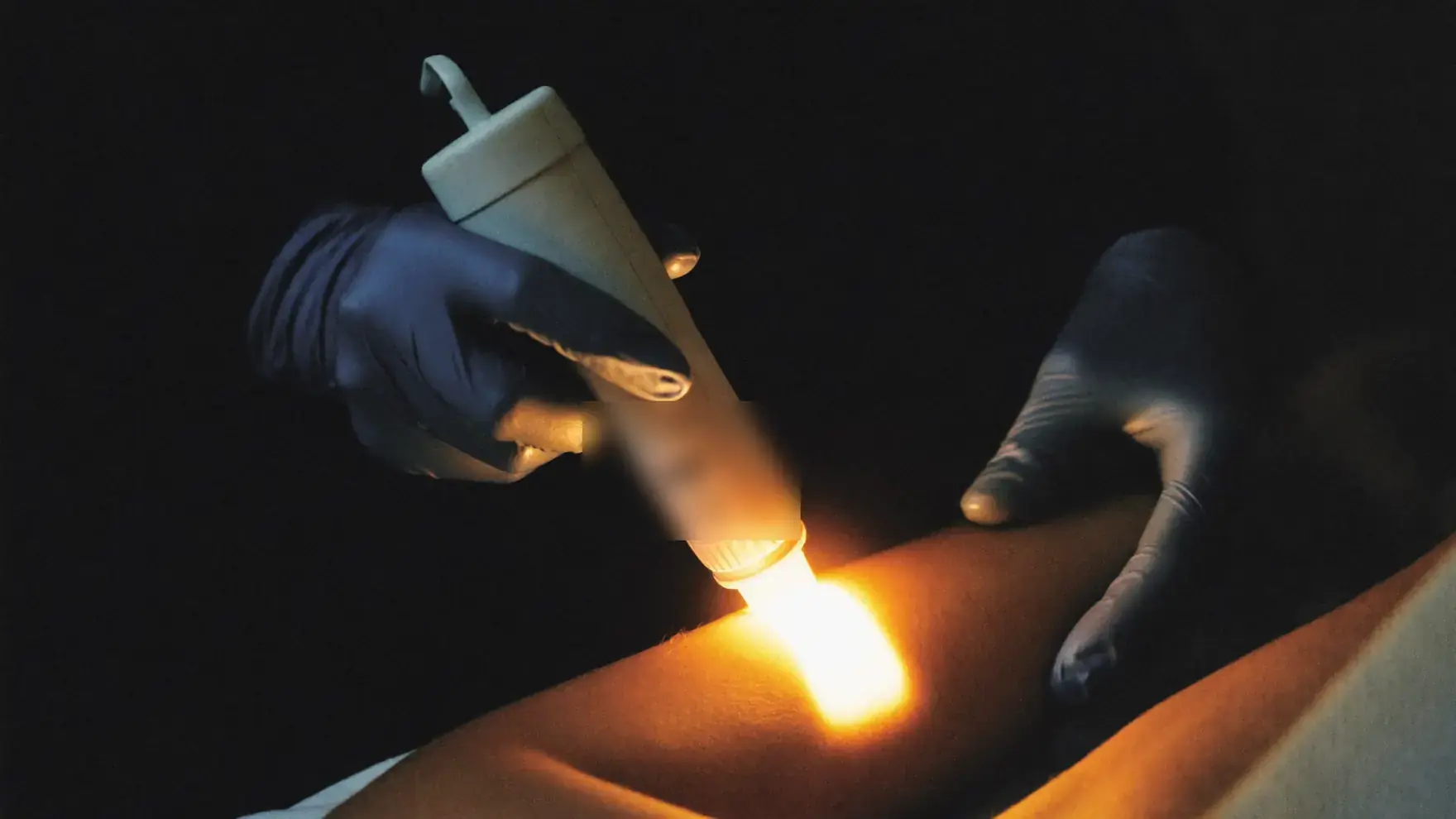 Destello de luz pulsada intensa sobre la piel durante una sesión de IPL